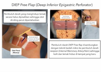 Teknik Operasi Bedah Mikro Untuk Rekonstruksi Payudara