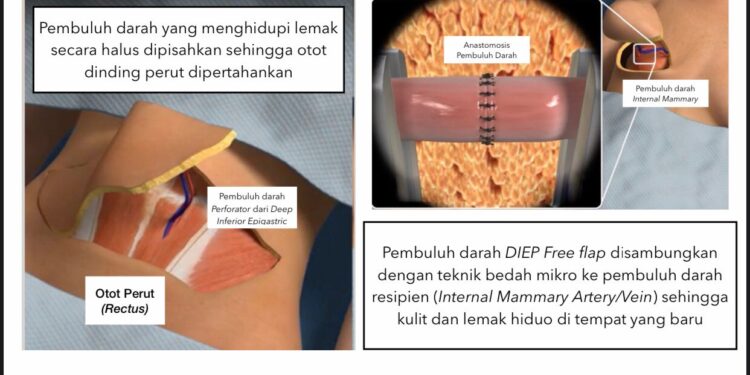 Teknik Operasi Bedah Mikro Untuk Rekonstruksi Payudara
