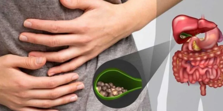 Tips Kesehatan Membuang Batu Empedu.