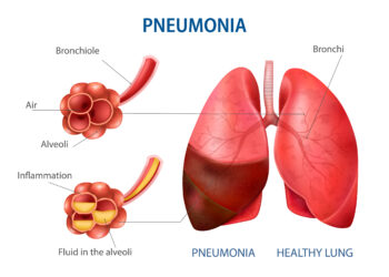 Waspada Pneumonia: Kenali Gejala dan Cara Penanganannya