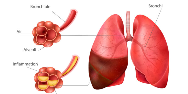 Waspada Pneumonia: Kenali Gejala dan Cara Penanganannya