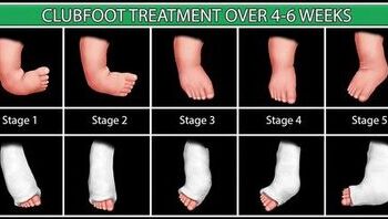 Mengenal Kaki Pengkor (Clubfoot) pada Anak: Penyebab, Gejala, dan Pengobatan