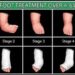 Mengenal Kaki Pengkor (Clubfoot) pada Anak: Penyebab, Gejala, dan Pengobatan