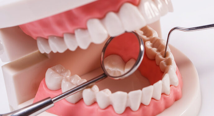 Sakit Gigi Tak Kunjung Sembuh? Root Canal Treatment Bisa Menjadi Solusi untuk Menyelamatkan Gigi Asli