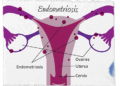 Benarkah Kista Endometriosis Bisa Menyebabkan Sulit Hamil? Ini Penjelasan Dokter