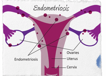 Benarkah Kista Endometriosis Bisa Menyebabkan Sulit Hamil? Ini Penjelasan Dokter