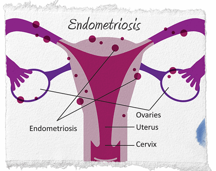 Benarkah Kista Endometriosis Bisa Menyebabkan Sulit Hamil? Ini Penjelasan Dokter
