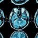 Tergolong Cedera Otak Traumatik yang Parah, Apa itu Diffuse Axonal Injury?