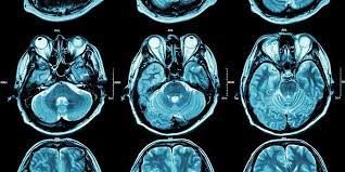 Tergolong Cedera Otak Traumatik yang Parah, Apa itu Diffuse Axonal Injury?
